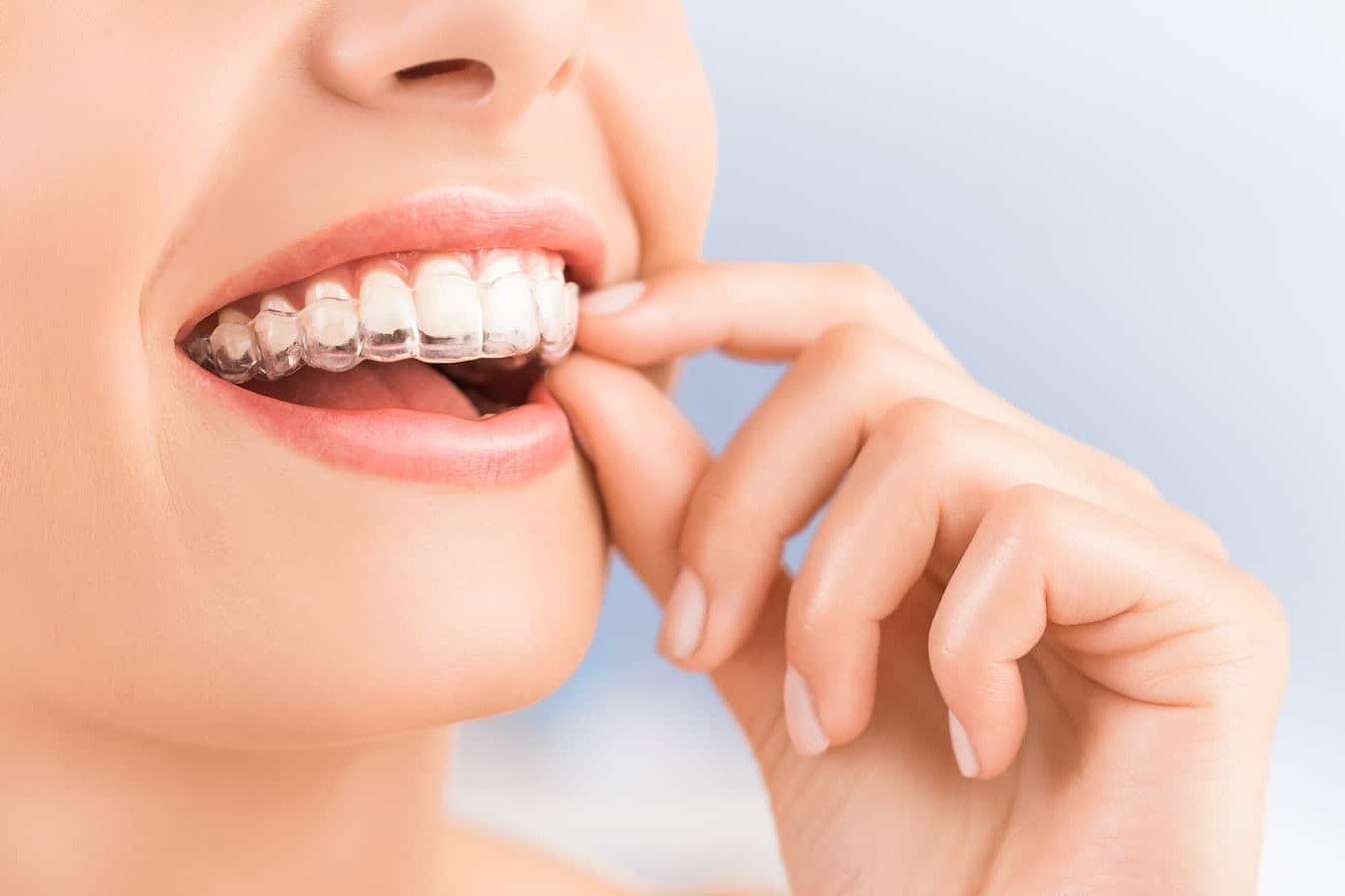 29 Fakta Om Invisalign