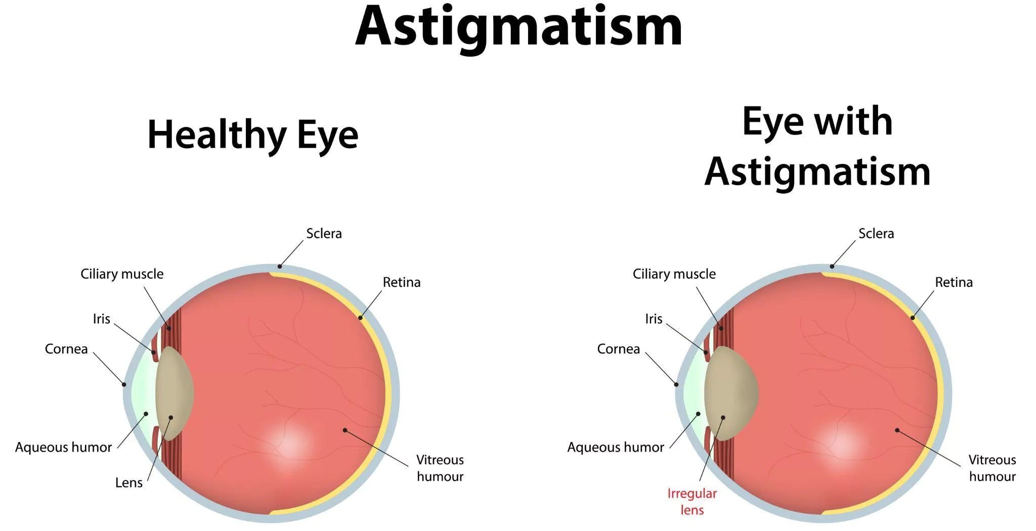 35 Fakta Om Astigmatisme