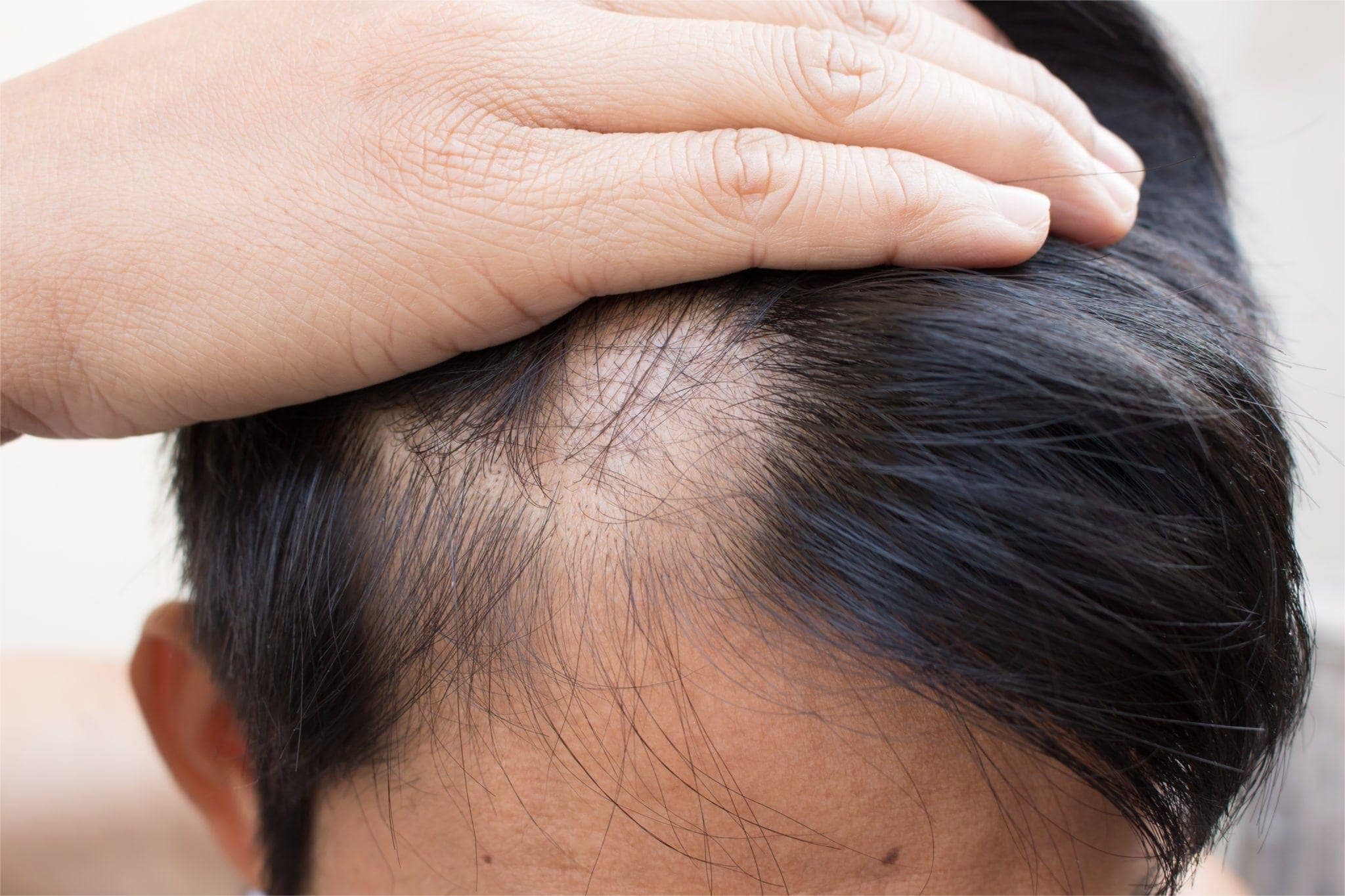 36 Fakta Om Alopeci