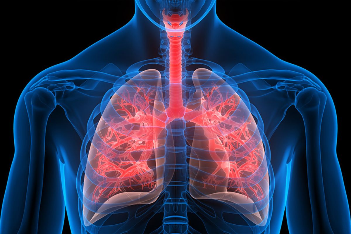 36 Fakta Om Cystisk Fibrose