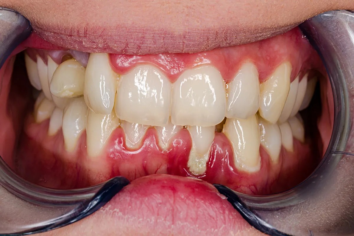 36 Fakta Om Gingivitis